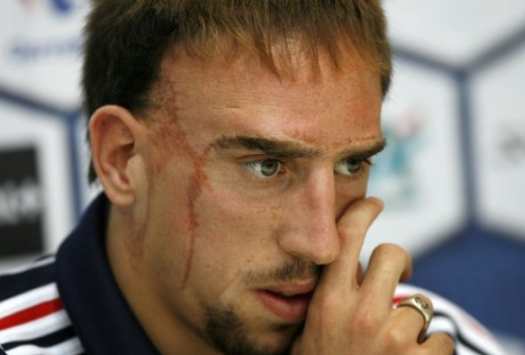 Franck Ribery scars photo